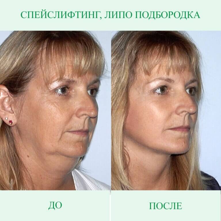 Эффект спейслифтинга