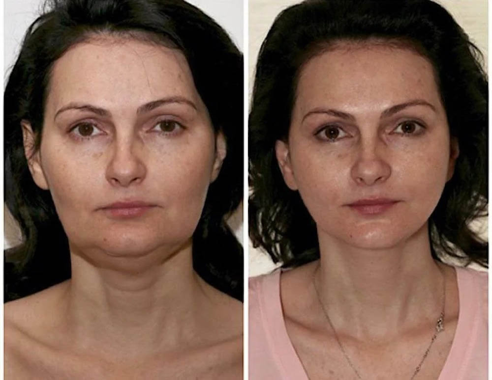 Спейслифтинг фото до&nbsp;после