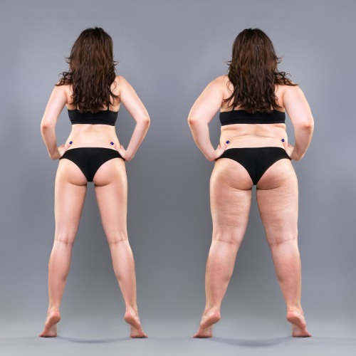 Операция для стройных ног