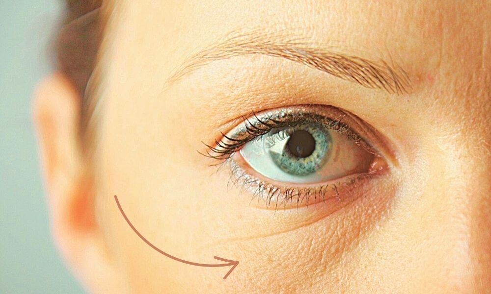 Мешки под&nbsp;глазами откуда они и&nbsp;как бороться с&nbsp;суфами?