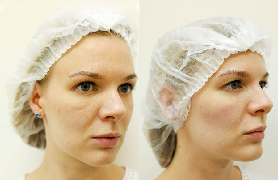 Фото до&nbsp;после коррекции малярных мешков