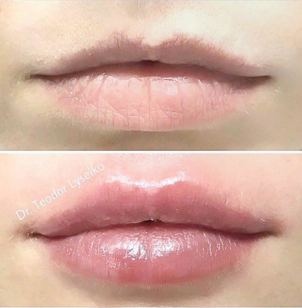 Фото до&nbsp;после увеличения губ ангельские крылья