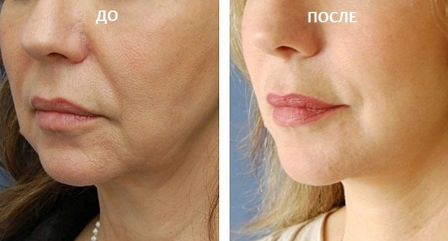 Нитевой лифтинг губ фото до&nbsp;после