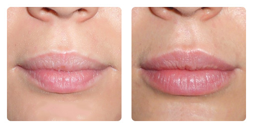 Увеличение губ фото до&nbsp;после &ndash; линейная техника