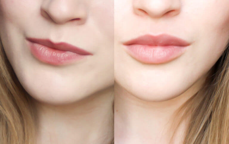 Фото до&nbsp;после увеличения губ &ndash; голливудский объем