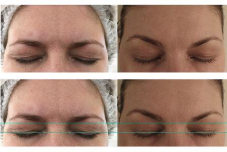 Фото до после лифтинга