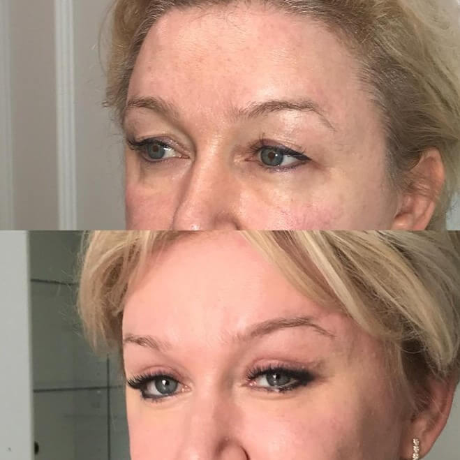 Топ-лифтинг  фото до после пластической операции