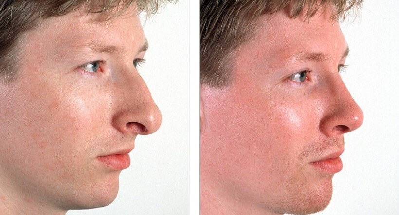 Мужская ринопластика фото до&nbsp;после