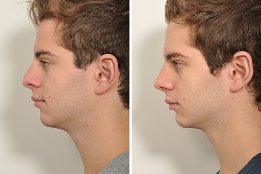 Мужская ринопластика