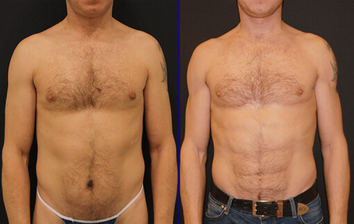 Фото до&nbsp;после липосакции мужчин