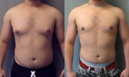Мужская липосакция фото до&nbsp;после