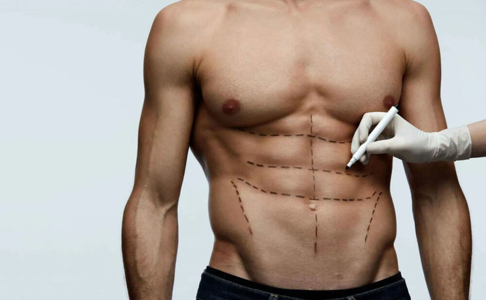 Пластика живота для&nbsp;мужчин