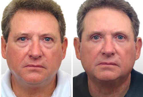 Мужская блефаропластика фото до&nbsp;после