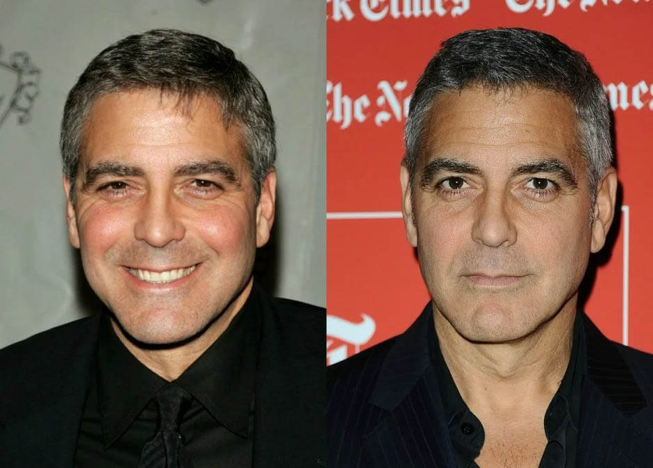 Фото до&nbsp;после мужской блефаропластики Джорджа Клуни