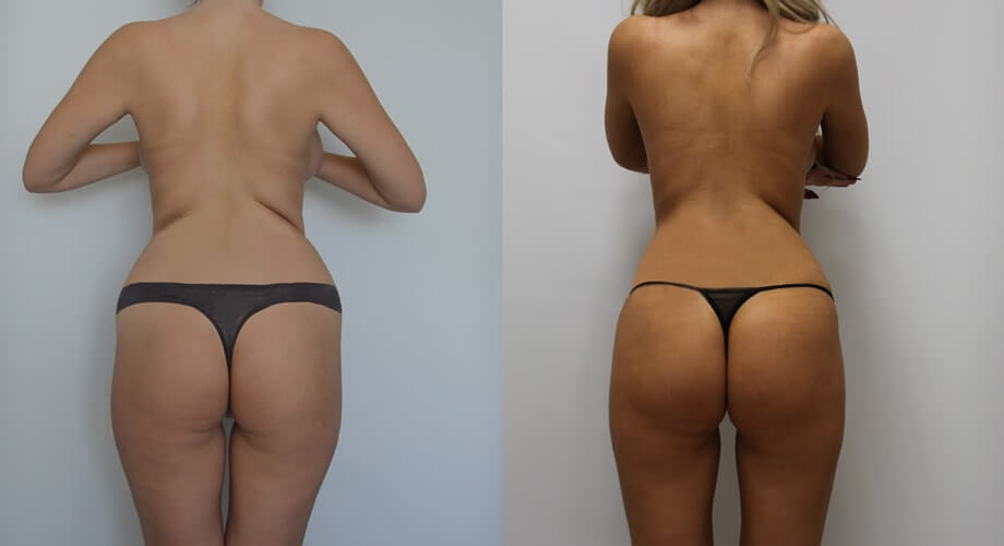 Фото до после липосакции бедер
