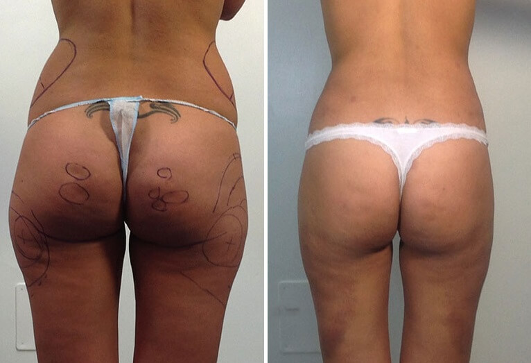 Фото до после липосакции бедер в зоне галифе