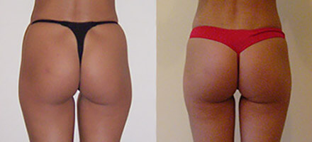 Фото до после липосакции бедер