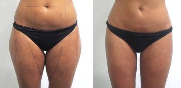 Липосакция бедер фото до после