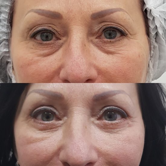 Удаление малярных мешков — фото до после