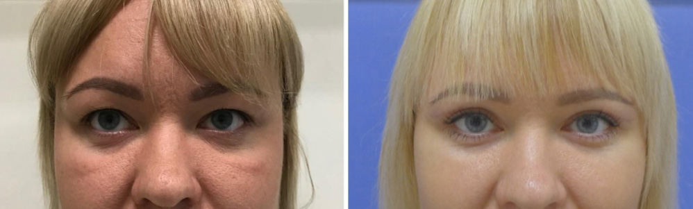 Фото до после удаления малярных мешков