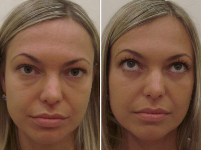 Фото до после удаления малярных мешков