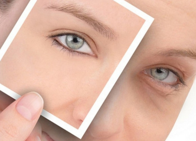 Удаление малярных мешков под глазами 