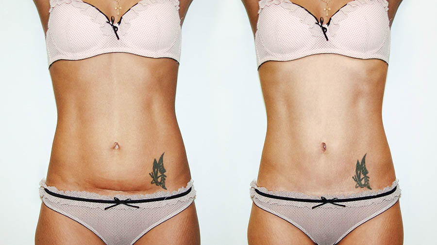 Миниабдоминопластика фото до&nbsp;после