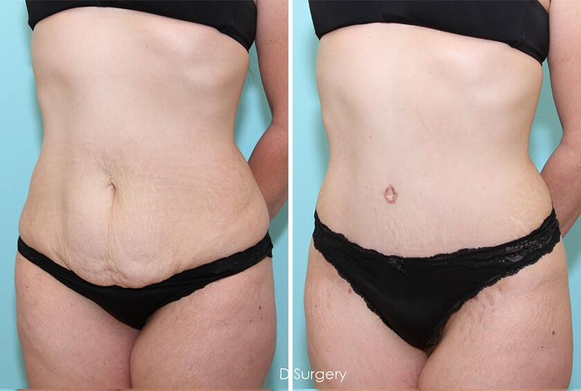 Фото до&nbsp;после пластики живота &ndash; удаляем фартук