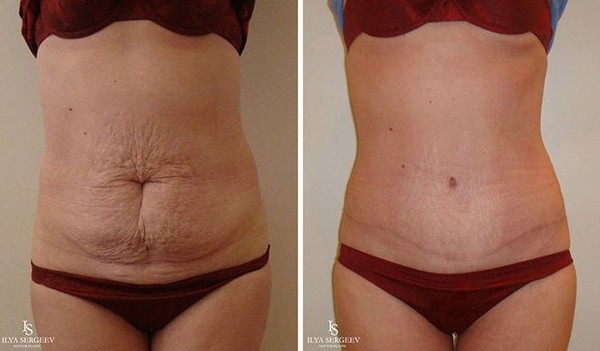 Фото до&nbsp;после пластики живота