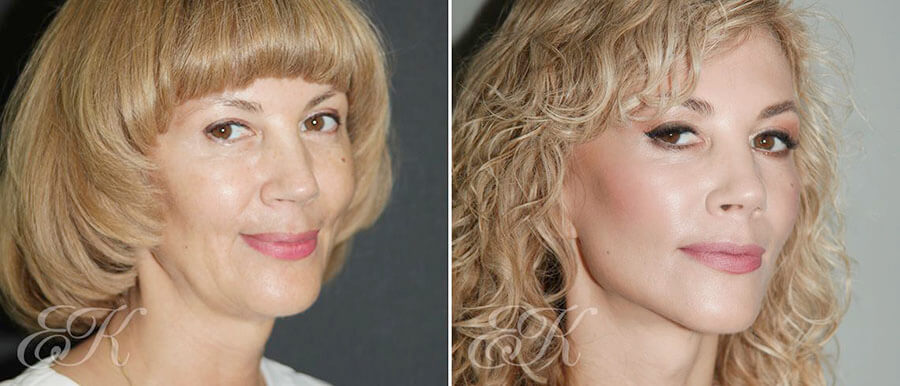 Фото до после умного омоложения