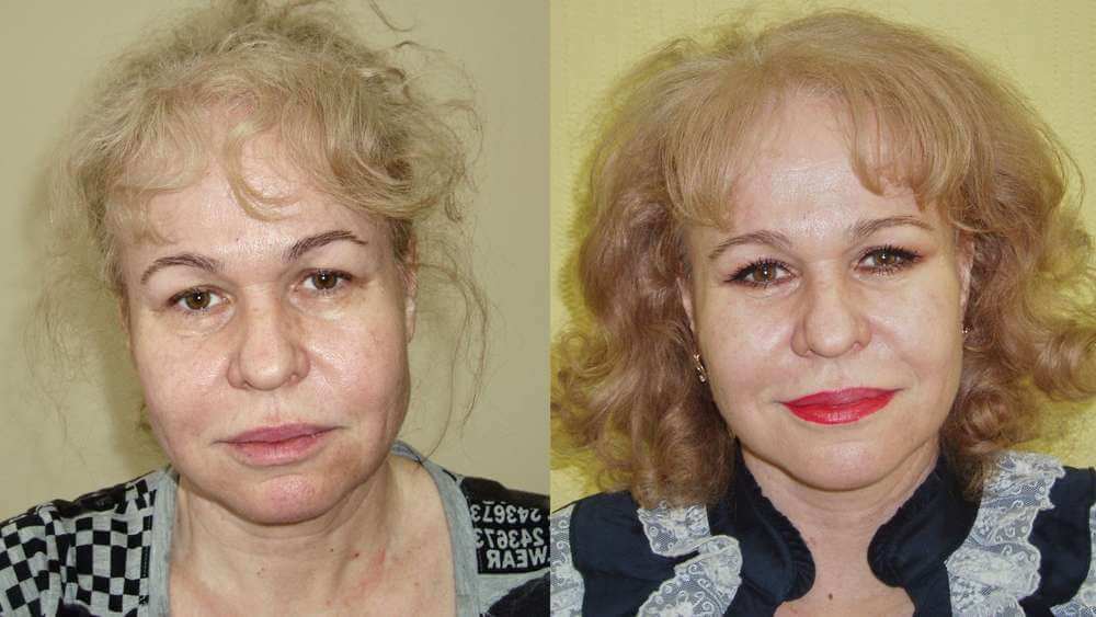 Омоложение лица фото до после HD-лифтинга