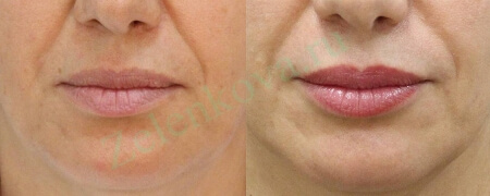 Фото до после увеличения губ — липофилинг