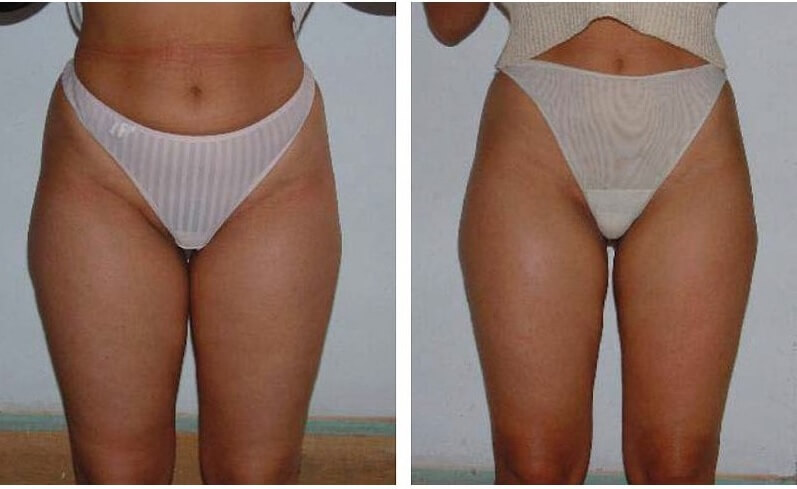 Фото до&nbsp;после липосакции ультразвуком