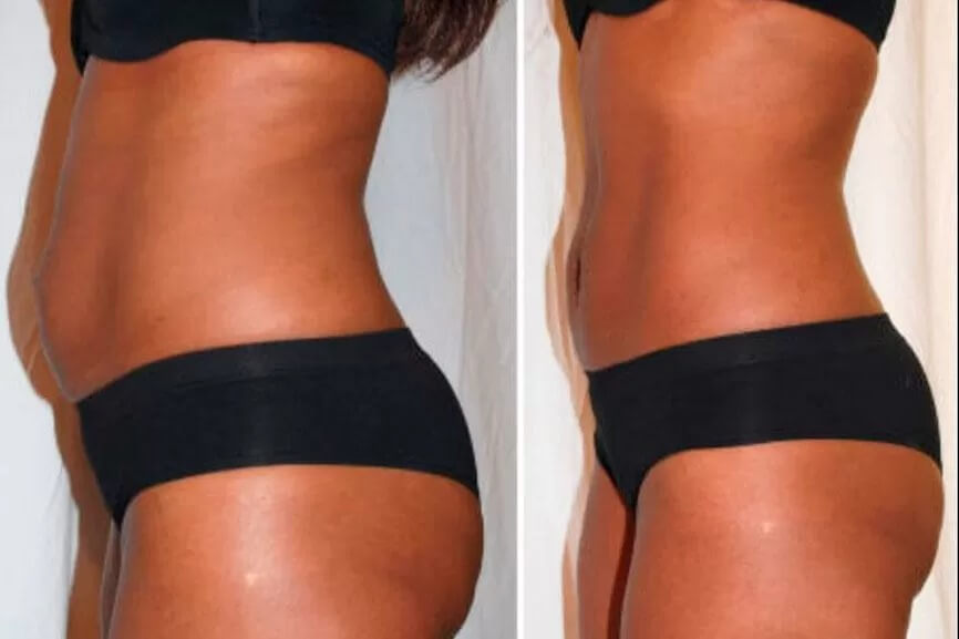 Ультразвуковая липосакция фото до&nbsp;после