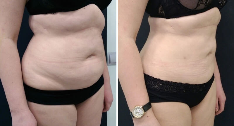 УЗ-липосакция фото до&nbsp;после