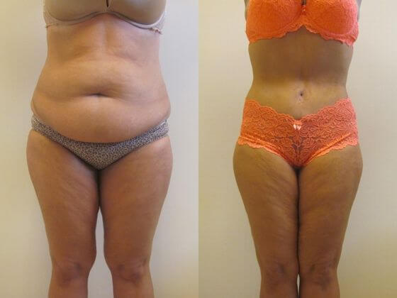 Пластика живота фото до&nbsp;после