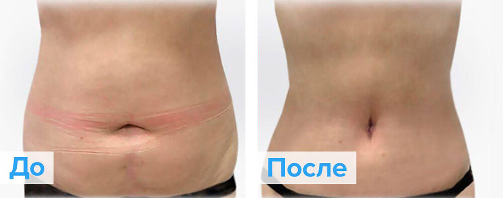 Фото до&nbsp;после миниабдоминопластики живота