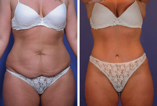 Фото до&nbsp;после абдоминопластики живота