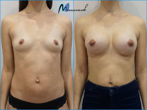 Фото до&nbsp;после пластики груди&nbsp;&mdash; аксиллярный доступ