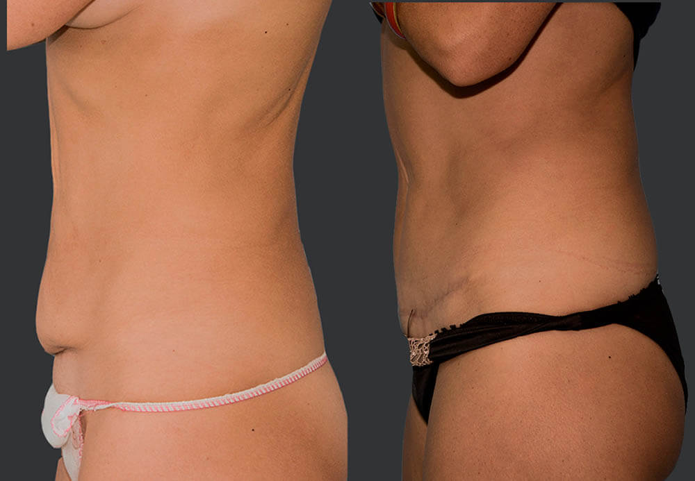 Фото до после пластики живота при похудении