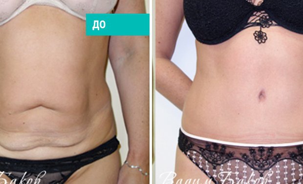 Подтяжка кожи живота фото до после