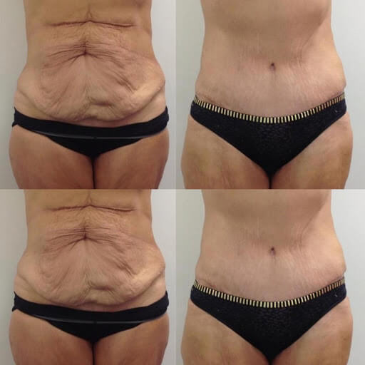 Фото до после подтяжки живота