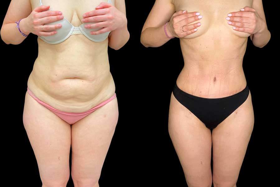 Фото до&nbsp;после липосакции после родов