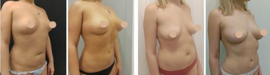 Фото до&nbsp;после маммопластики после родов