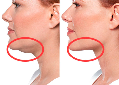 Косметологическая коррекция второго подбородка фото до&nbsp;после