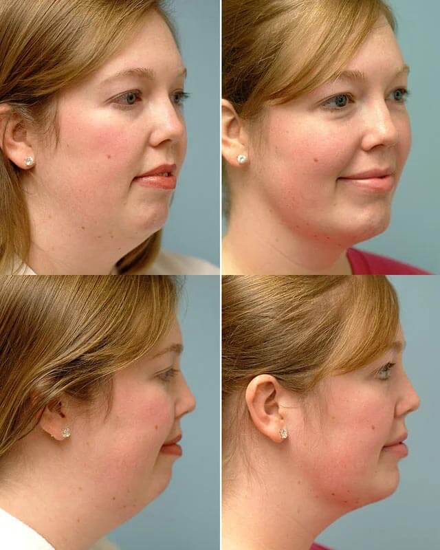 Фото до&nbsp;после коррекции второго подбородка