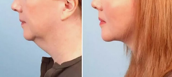 Фото до&nbsp;после подтяжки второго подбородка