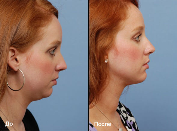 Как убрать второй подбородок фото до&nbsp;после