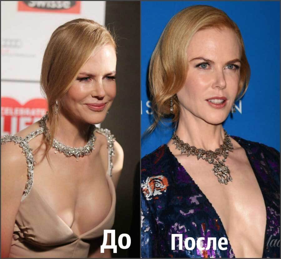Удаление грудных имплантов фото до&nbsp;после