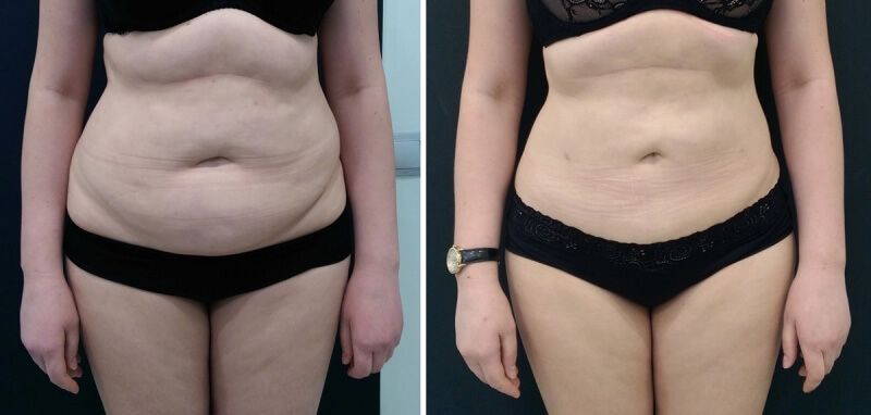 Фото до&nbsp;и&nbsp;после липосакции